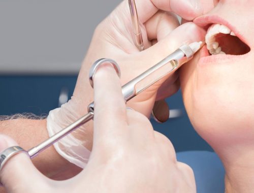 How Safe Is Intravenous Sedation for Dental Procedures